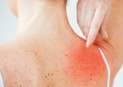 Sluneční alergie: Jak jí předcházet a léčit příznaky
